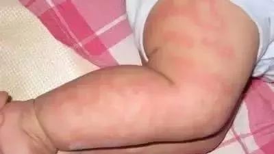 寶寶奶粉過敏怎麼破？